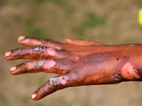 shutterstock_89717047_burning injuries_apdegumi.jpg