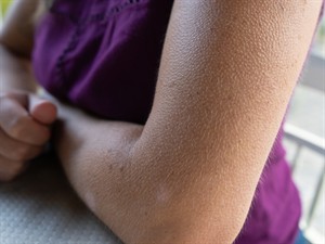shutterstock_2338783815_Goosebumps_Zosāda.jpg