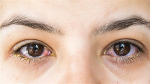 shutterstock_2596064537_eyes with conjunctivitis_Acis ar konjunktivītu.jpg