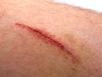 shutterstock_1072646660_wound_rēta.jpg