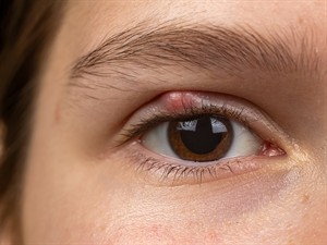 shutterstock_2456533709_Chalazion on the eyelid_Miezis uz acs plakstiņa.jpg
