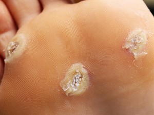 shutterstock_1031229142_warts_kārpas.jpg