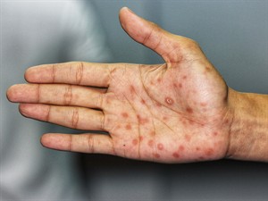 shutterstock_1024557601_secondary stage syphilis_sifilisa otrā stadija.jpg