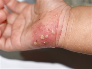 shutterstock_1499208245_scabies_kašķis.jpg