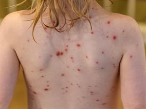 Shutterstock_2223751353_chicken pox_vējbakas.jpg