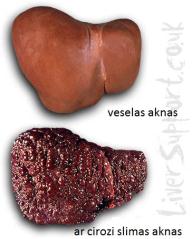 liver_cirrhosis_67105924d.jpg