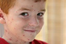 boy-with-chicken-pox.jpg
