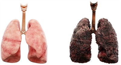 shutterstock_570778996_healthy and unhealthy lungs_veselīgas un neveselīgas plaušas.jpg