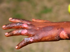 shutterstock_89717047_burning injuries_apdegumi.jpg