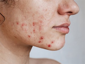 shutterstock_2368271029_acne_akne.jpg