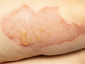 shutterstock_2134754807_burn_apdegums.jpg