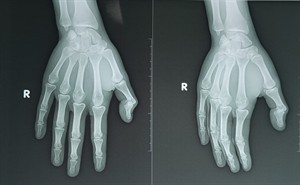 shutterstock_2532665925_two hands x-ray_divu roku rentģens.jpg