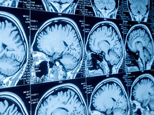 shutterstock_1485142691_Magnetic resonance image of the brain_galvas smadzeņu magnētiskās rezonanses attēls.jpg